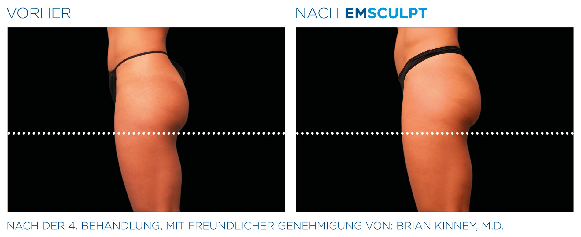 EMSculpt Vorher-Nachher