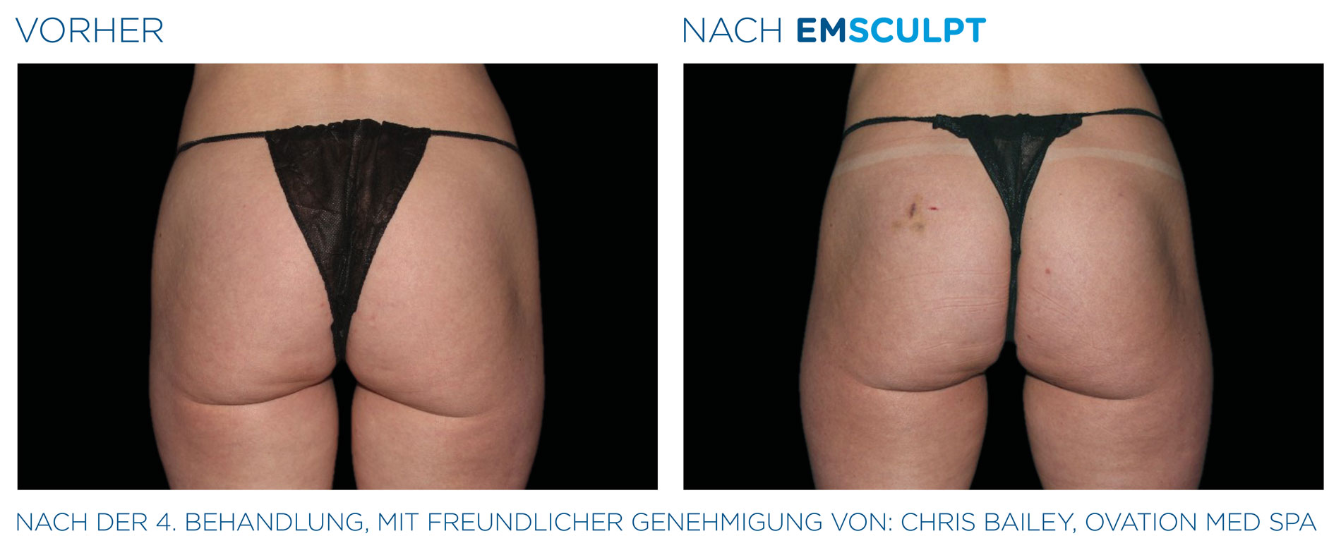 EMSculpt Vorher-Nachher