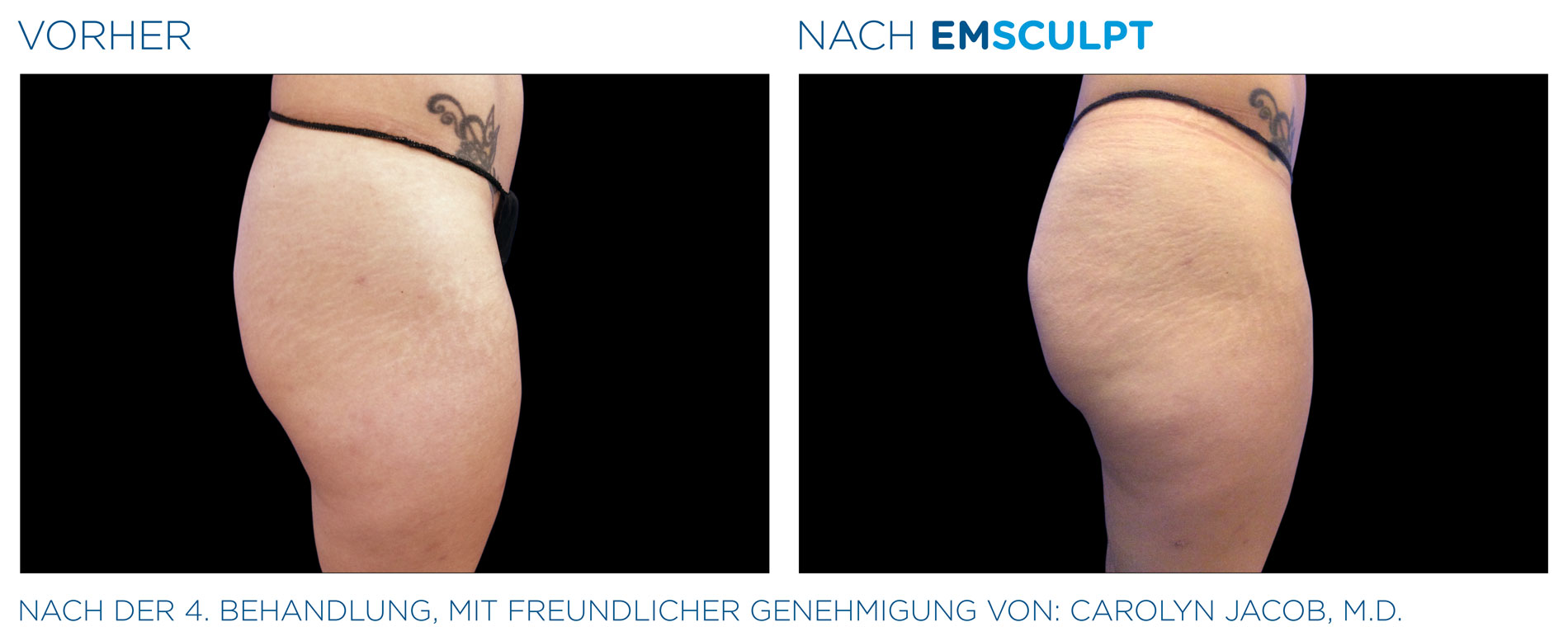 EMSculpt Vorher-Nachher