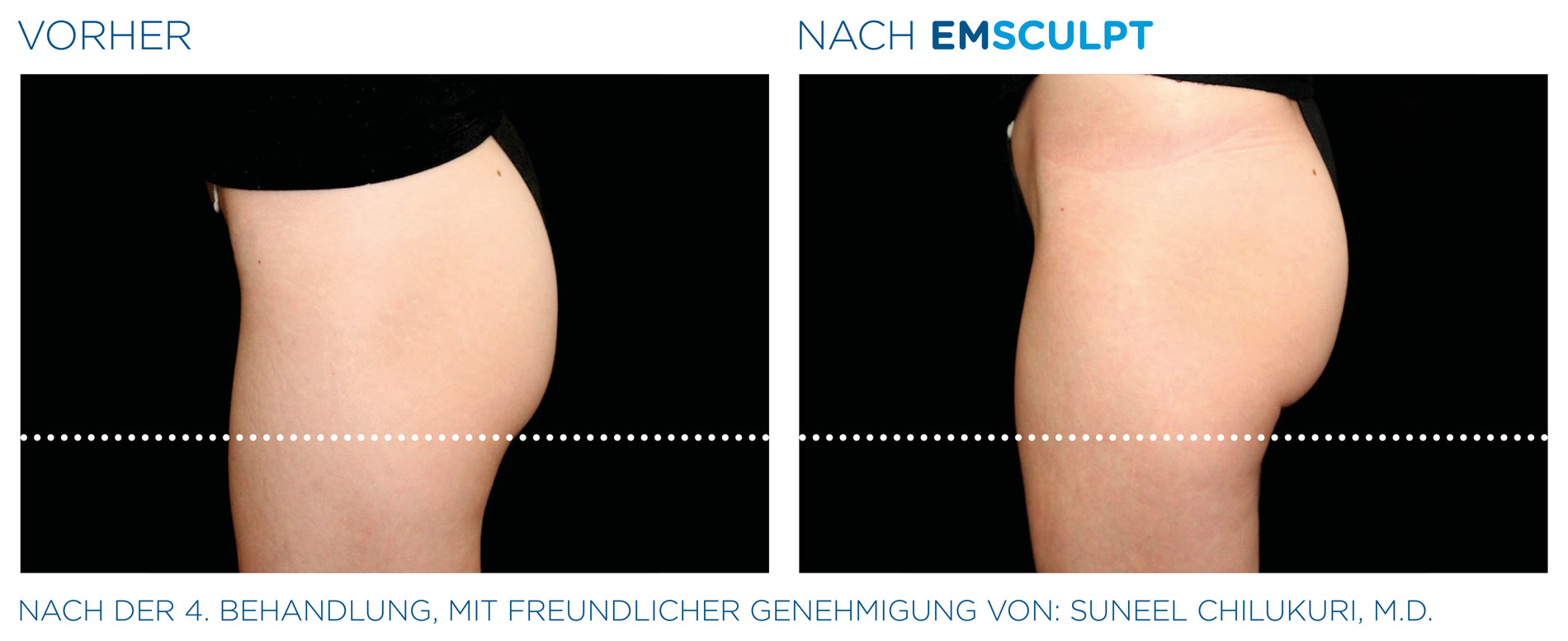 EMSculpt Vorher-Nachher