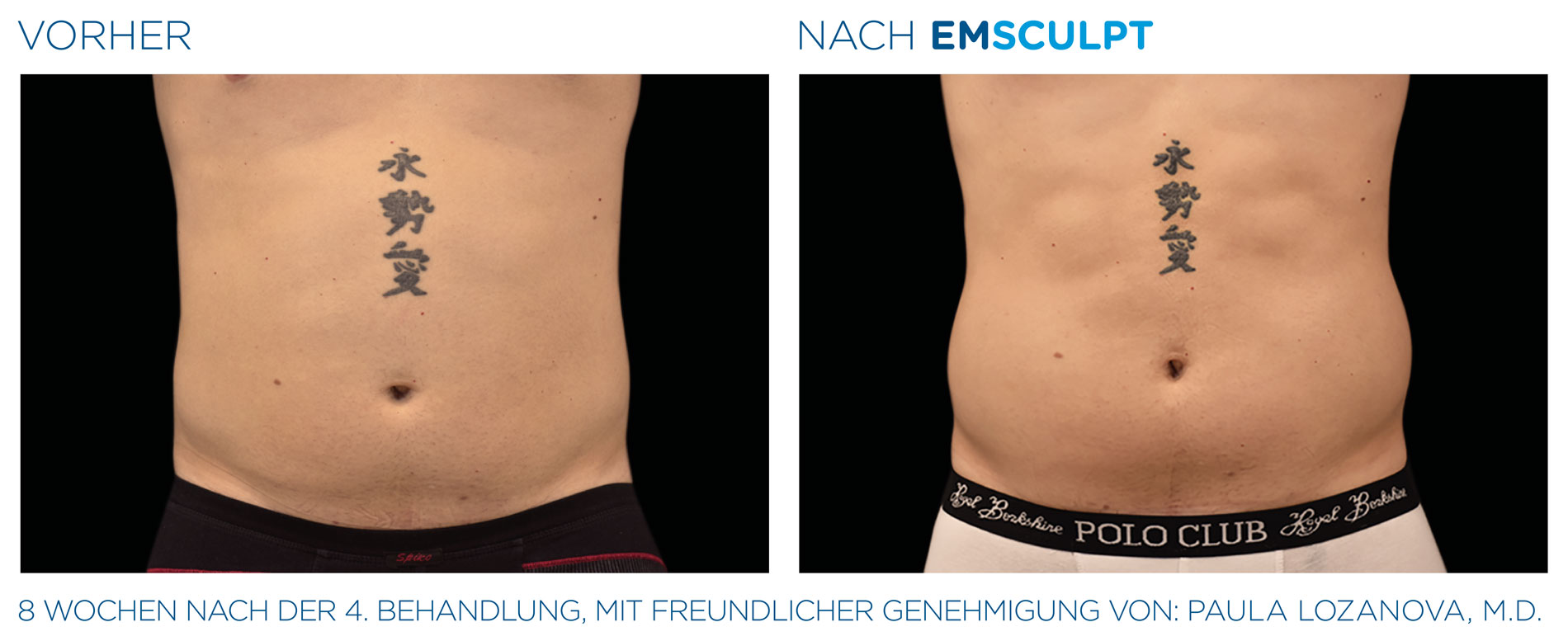 EMSculpt Vorher-Nachher