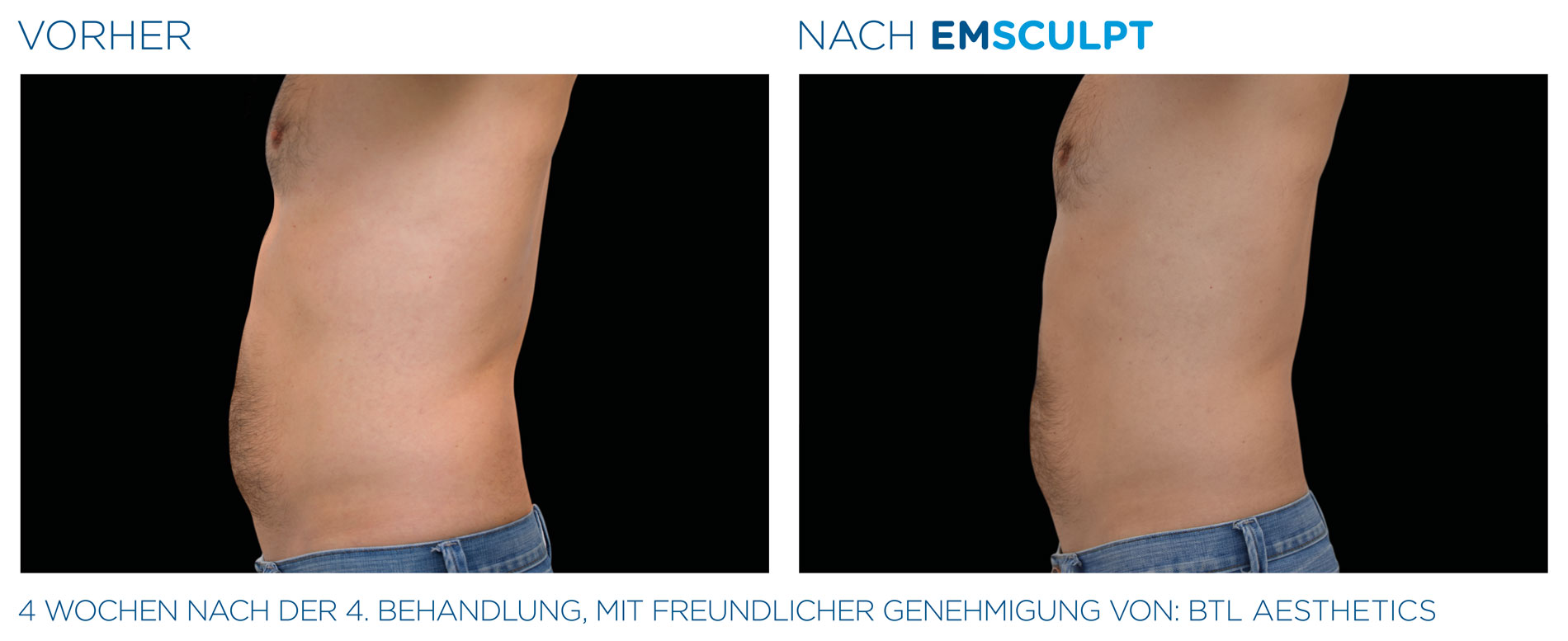 EMSculpt Vorher-Nachher