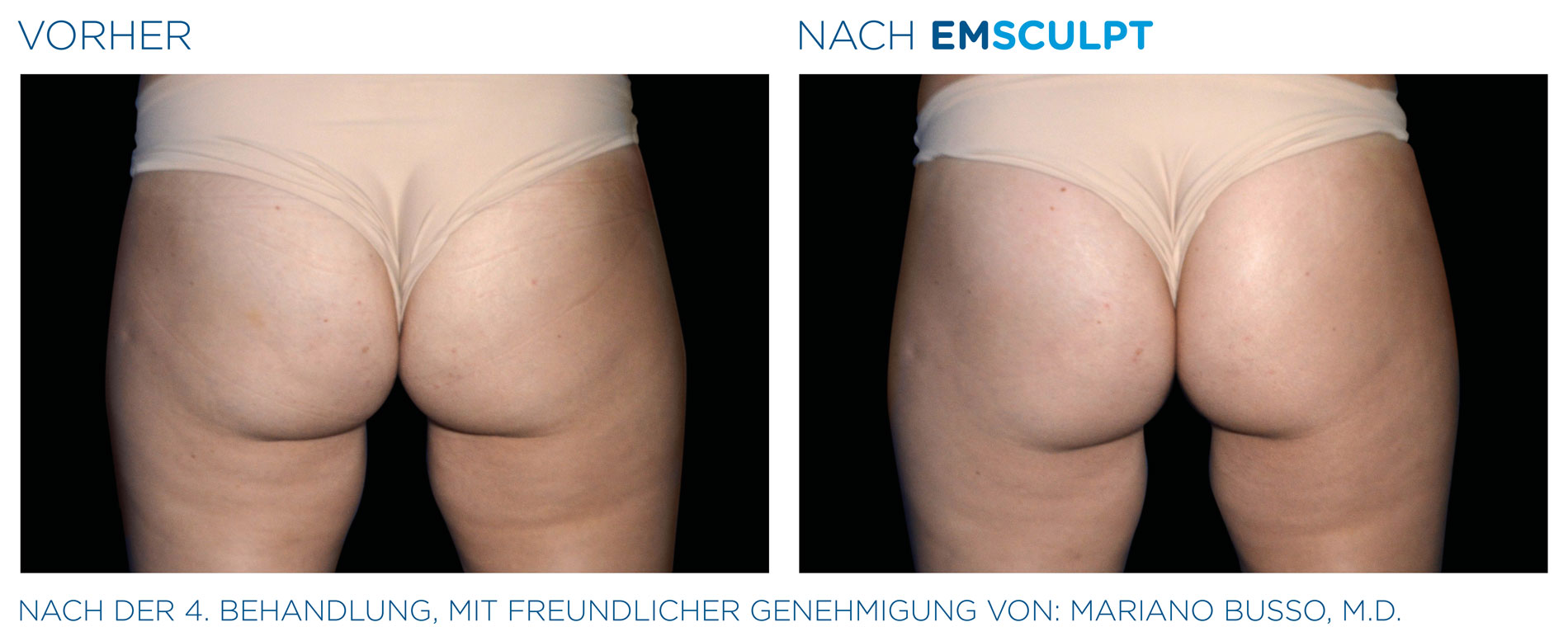 EMSculpt Vorher-Nachher