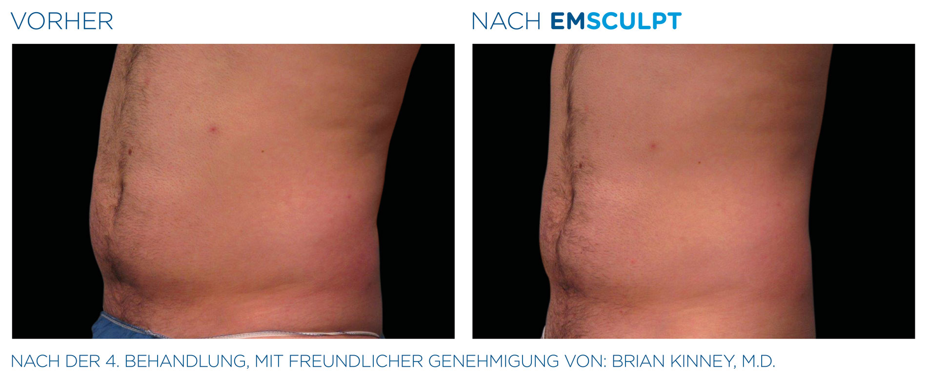 EMSculpt Vorher-Nachher