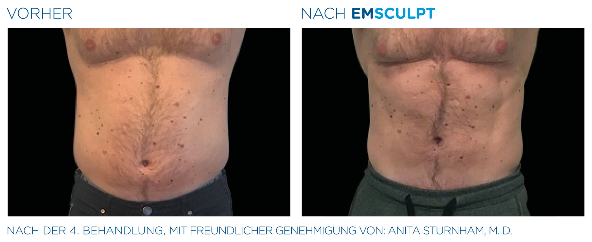 EMSculpt Vorher-Nachher