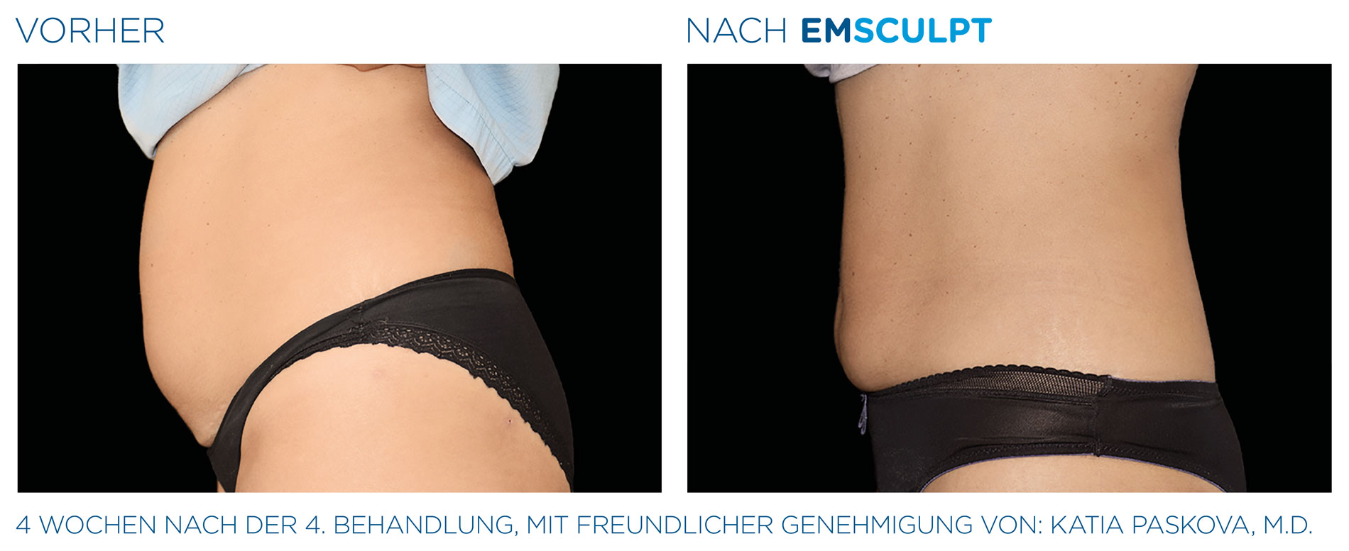 EMSculpt Vorher-Nachher