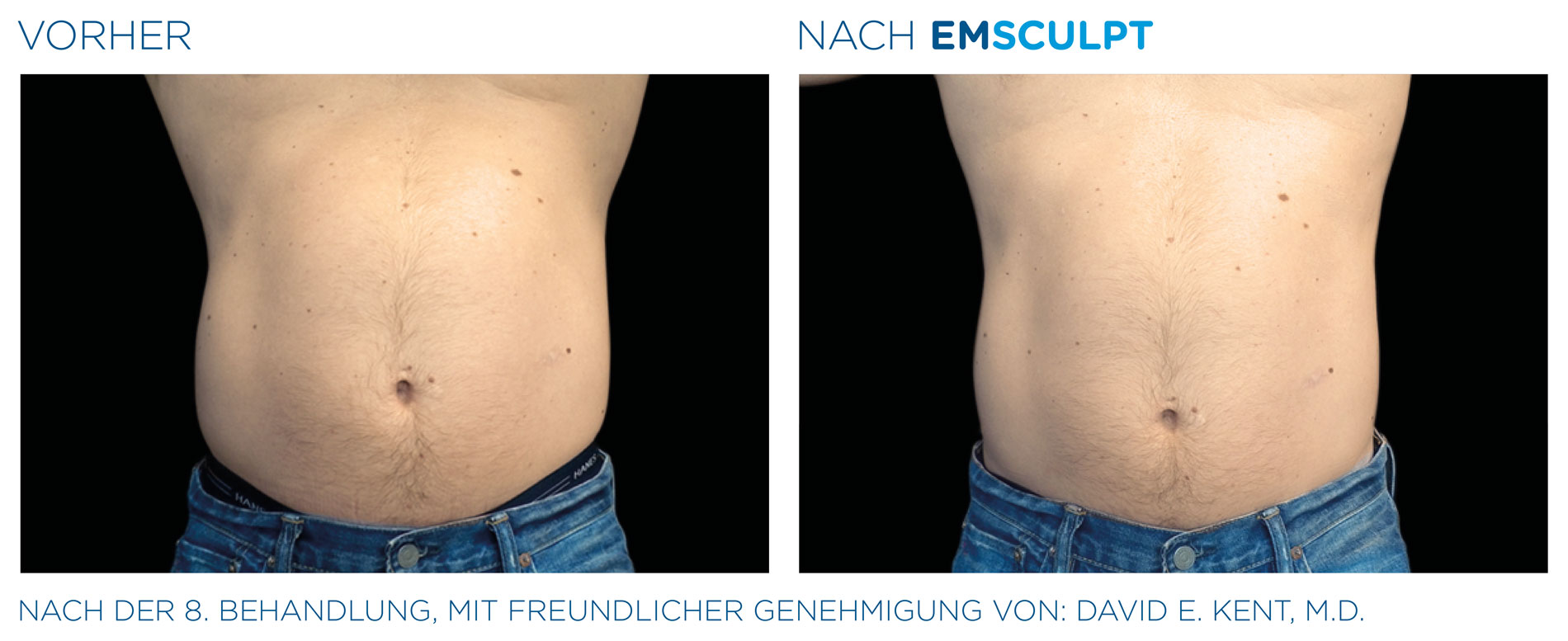 EMSculpt Vorher-Nachher