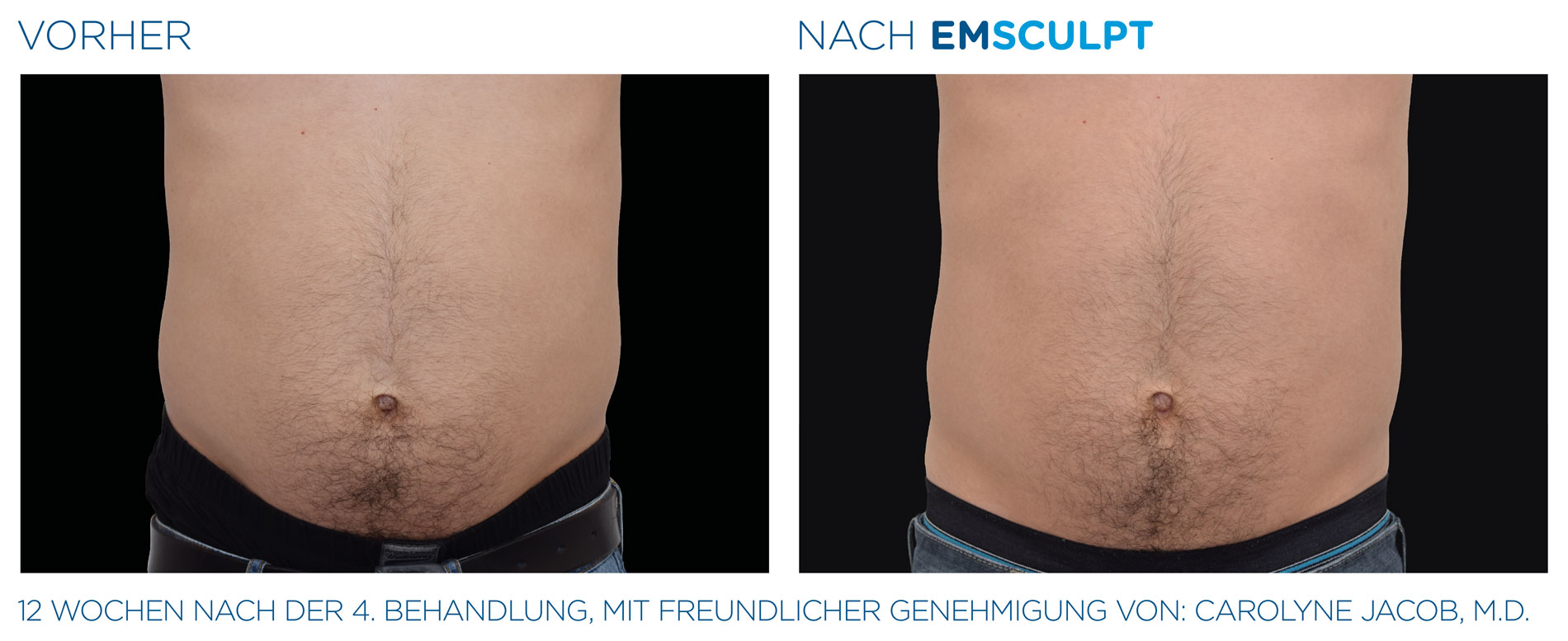 EMSculpt Vorher-Nachher