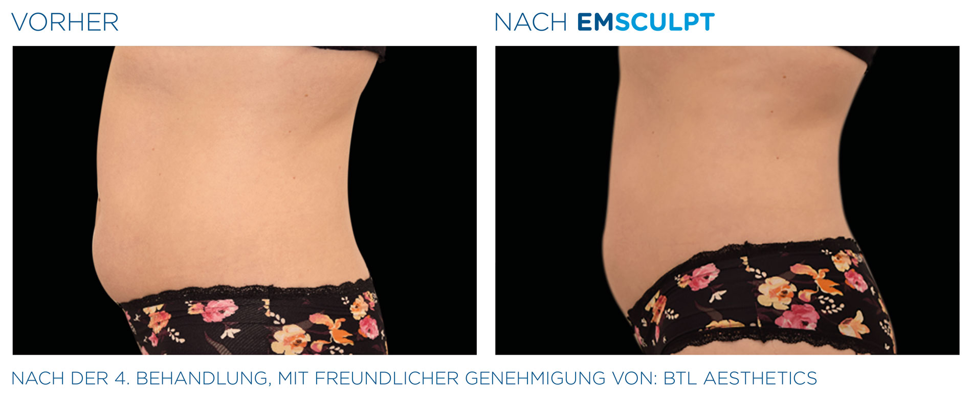 EMSculpt Vorher-Nachher