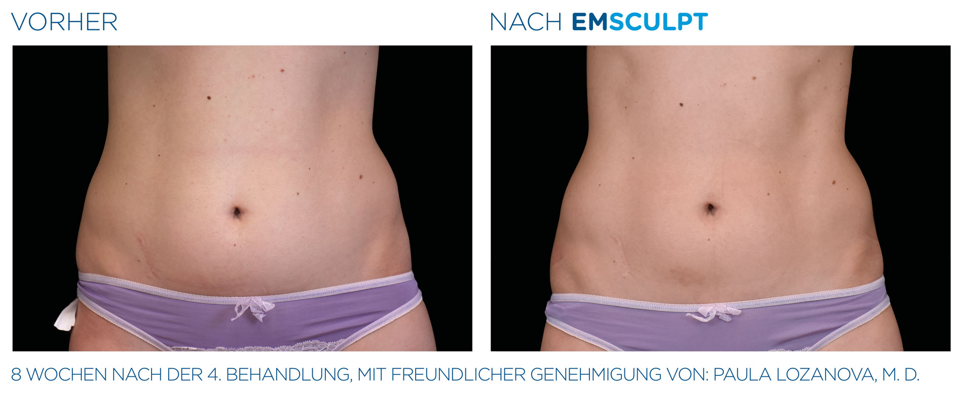 EMSculpt Vorher-Nachher