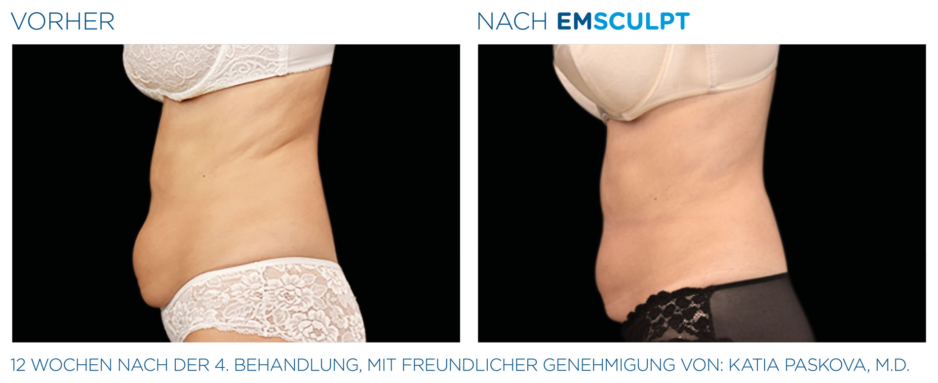 EMSculpt Vorher-Nachher