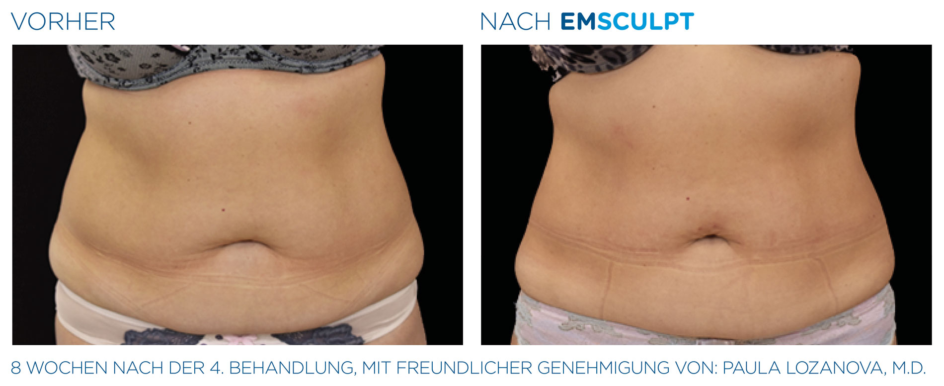 EMSculpt Vorher-Nachher