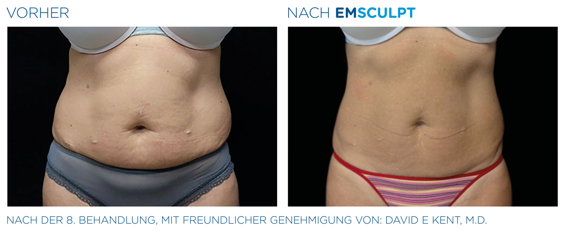 EMSculpt Vorher-Nachher