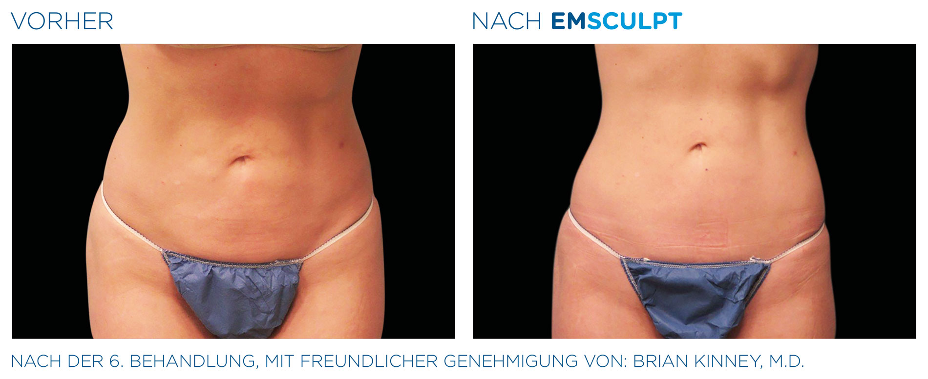 EMSculpt Vorher-Nachher