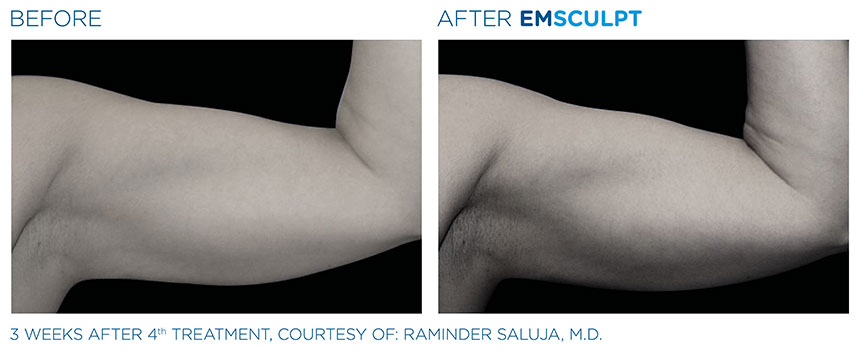 EMSculpt Vorher Nachher Frau Arm