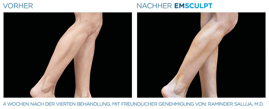 Vorher Nachher Bilder Zu Emsculpt Behandlungen Emsculpt At